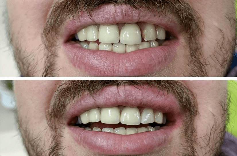 Зубные пломбы и лечение зубов
